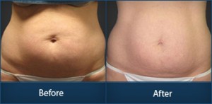 Body Contouring and Skin Tightening Treatment