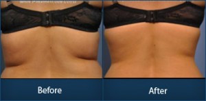Body Contouring and Skin Tightening Treatment