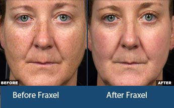 Fraxel Laser Treatment