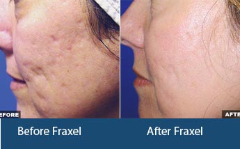 Fraxel Laser Treatment