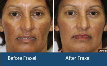 Fraxel Laser Treatment