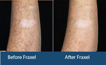 Fraxel Laser Treatment