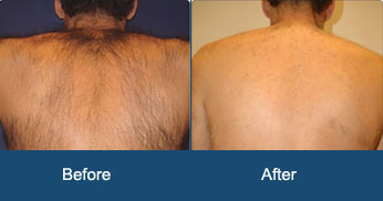 Laser Hair Removal Delhi