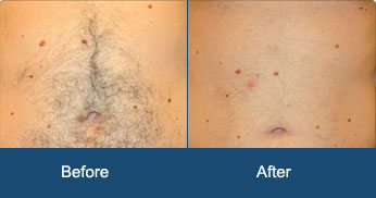 Laser Hair Removal in Delhi