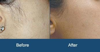 Permanent Laser Hair Removal Treatment