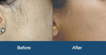 Laser Hair Removal Mumbai Permanent Hair Removal Treatment Cost India   The Esthetic Clinics