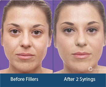 Dermal Fillers Treatment