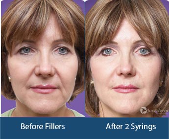 Dermal Fillers Treatment