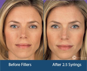 Dermal Fillers Treatment