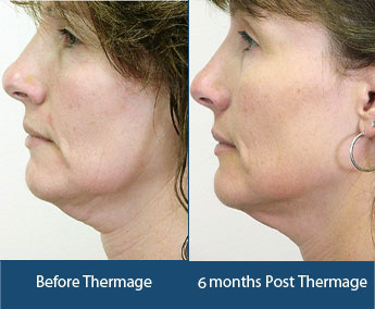 Thermage Treatment