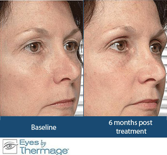 Thermage Treatment