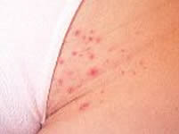 Razor Bumps, Razor Bumps Treatment, Razor Bumps Causes - Cosmetic