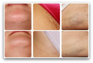 Razor Bumps, Razor Bumps Treatment, Razor Bumps Causes - Cosmetic