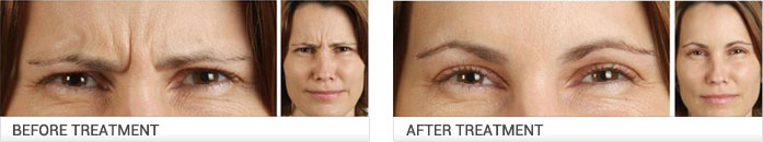 botox treatment