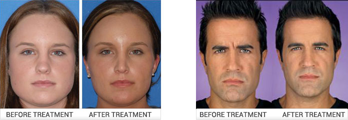 botox treatment