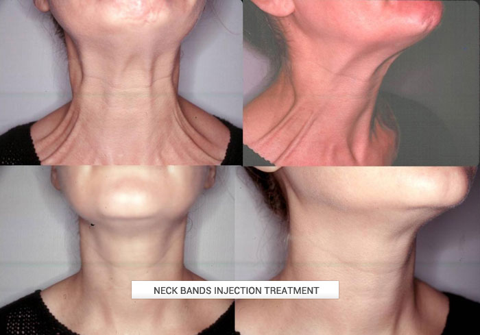 botox treatment after-before