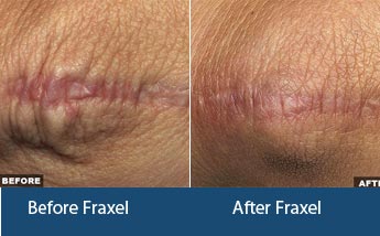 Fraxel Laser Treatment