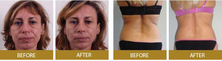 Power Plus Exilis Elite Treatment