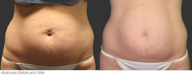 Exilis Elite Treatment