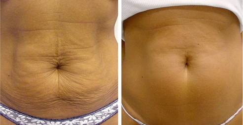 Exilis Elite Treatment