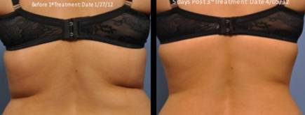 Exilis Elite Treatment