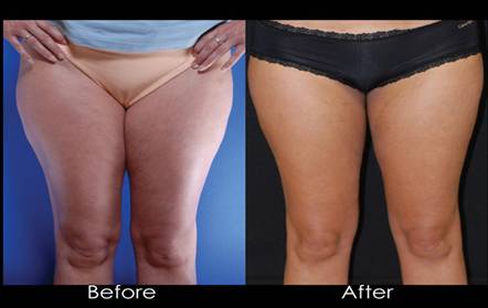 Exilis Elite Treatment