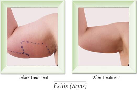 Exilis Elite Treatment