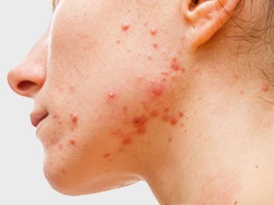 Active Acne Treatment