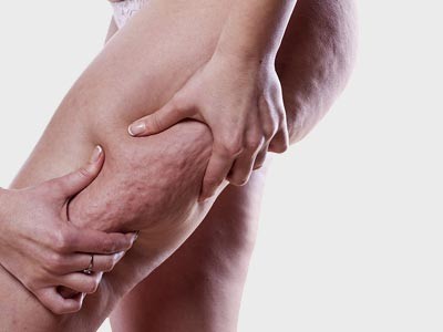 Cellulite Treatment Delhi