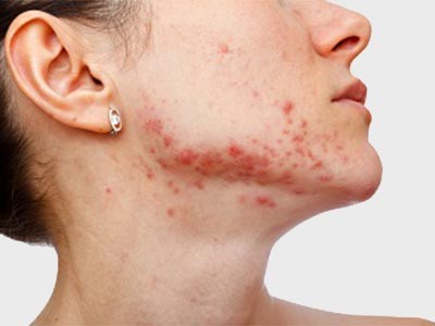 Rosacea Treatment Delhi