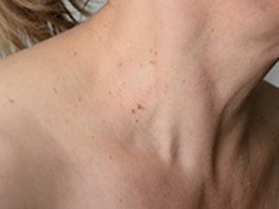 Skin Tags, Warts & Moles