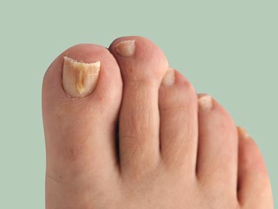 TOE Nail Fungus Treatment