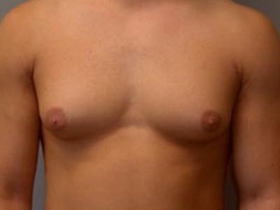 Male Gynecomastia Treatment